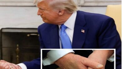 ابتلای ترامپ به «نارسایی مزمن وریدی»