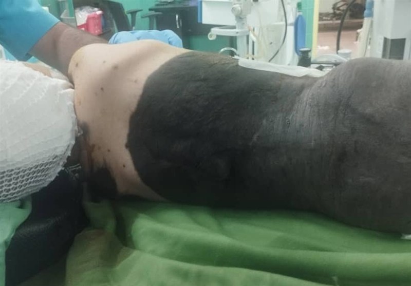 نجات کودک 3 ساله با جراحی مغز در بیرجند